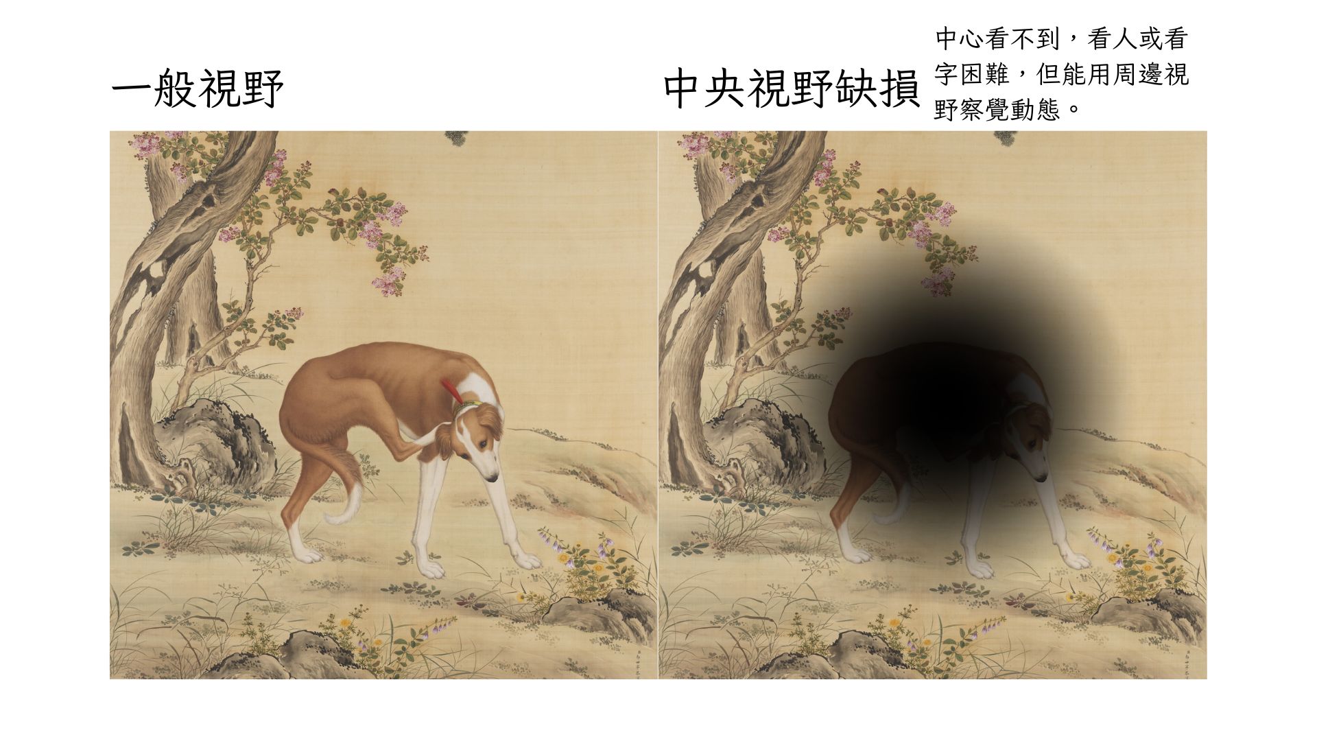 中央視野缺損中央模糊或黑斑四周清楚中心看不到看人或看字困難但能用周邊視野察覺動態