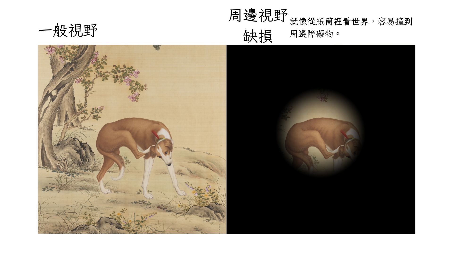 周邊視野缺損只有中央一小圈清楚四周全黑就像從紙筒裡看世界容易撞到周邊障礙物