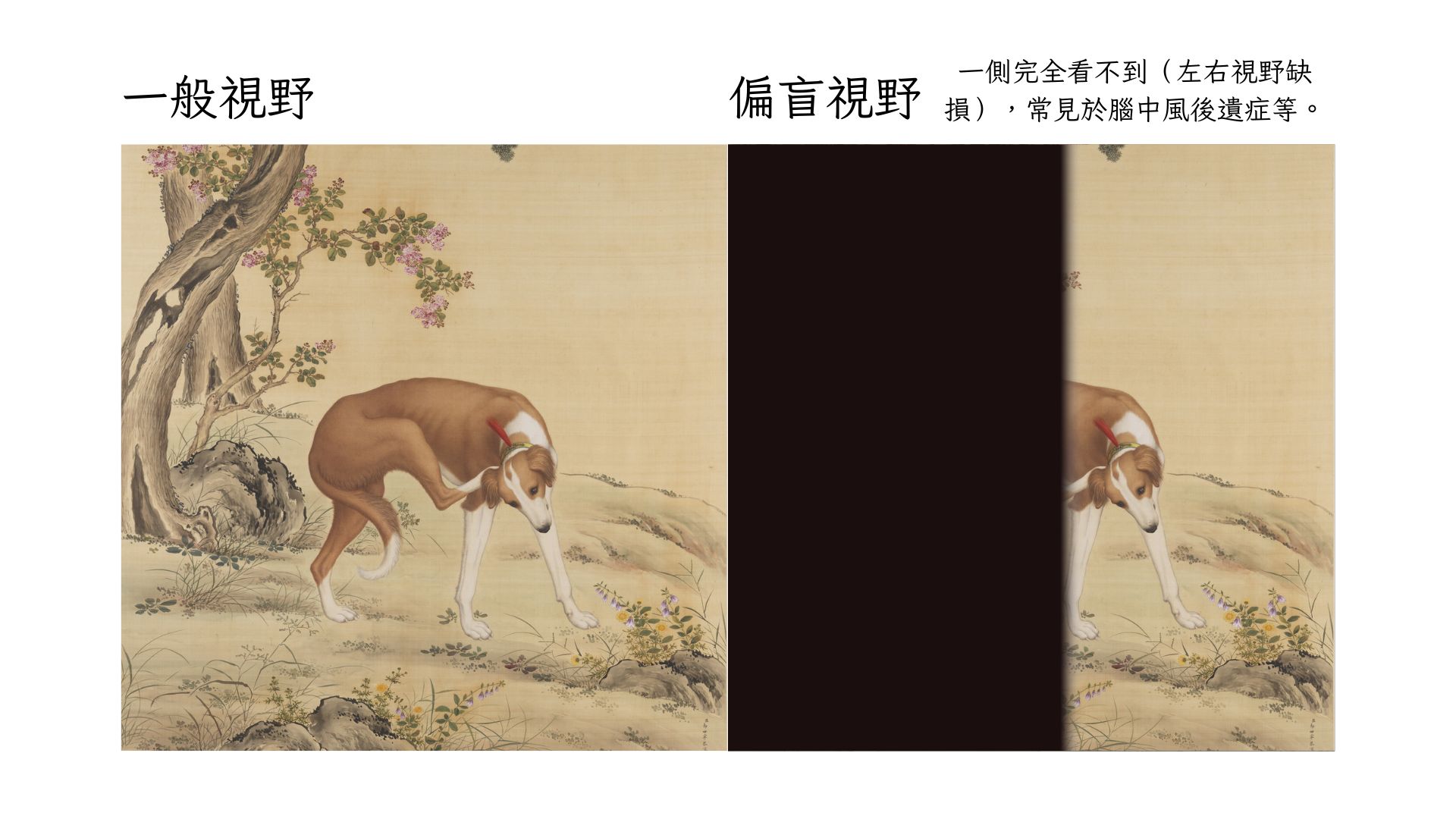 偏盲半邊畫面消失左半或右半一側完全看不到左右視野缺損常見於腦中風後遺症